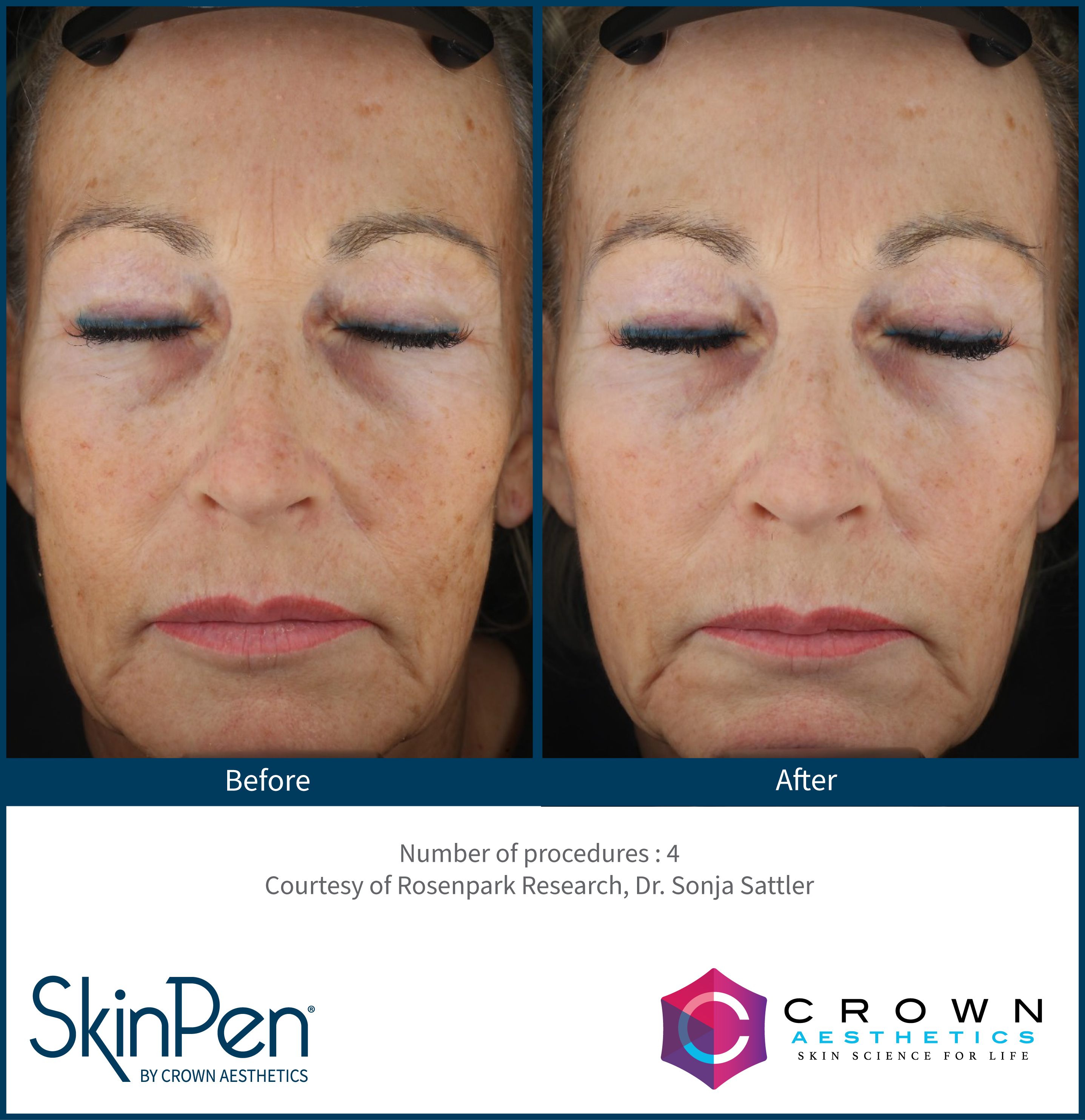 SkinPen pigmentation result example one